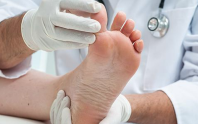 What Exactly Is A Hammertoe?